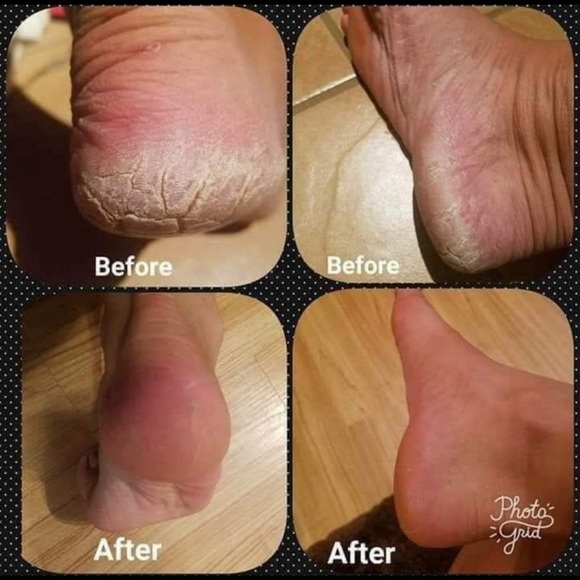 (1) Epoch Foot Treatment Sole solution - Picture 7 of 8